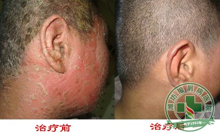 银屑病发病与T淋巴细胞有关系吗?