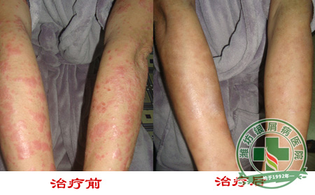 孕期银屑病患者吃红枣有什么好处?