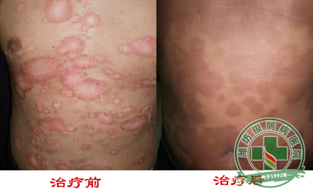 银屑病的引发与性格有关联？