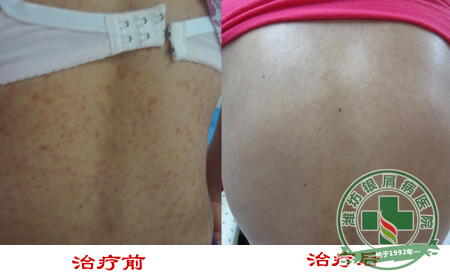 银屑病在夏季复发有哪些原因