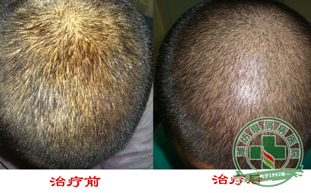 银屑病病情加重的原因是什么
