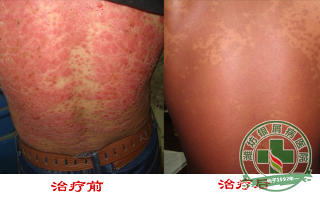 牛皮癣患者在夏季怎样护肤？