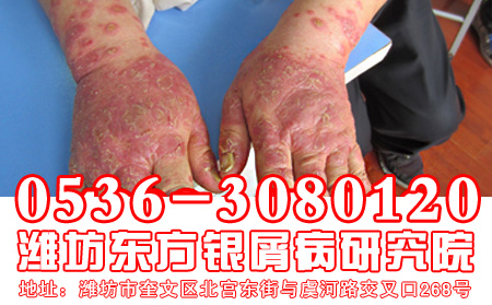 牛皮癣患者可以游泳吗?