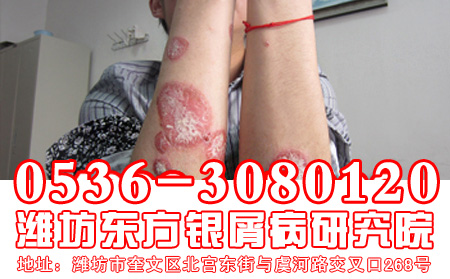 牛皮癣患者如何做到营养均衡？