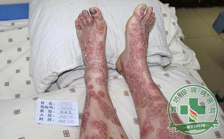 银屑病治疗