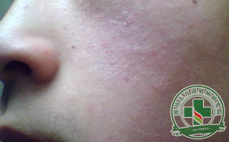 面部牛皮癣护理应注意什么