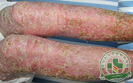长期治疗牛皮癣 使用药物效果怎么样