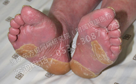 患上牛皮癣会有哪些危害