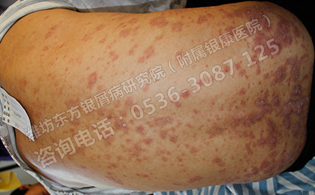 银屑病以哪些因素为主要诱因