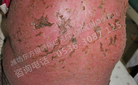 不治疗红皮型牛皮癣的危害是什么