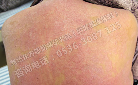 不同类型牛皮癣的诊断要点