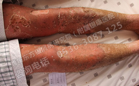 银屑病的类型都是哪些特征表现