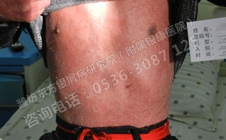 济南银屑病医院对于红皮型银屑病都有哪些治疗方法