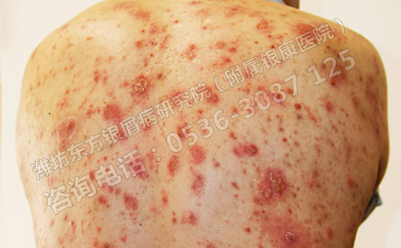 怎么有效的治疗顽固性银屑病