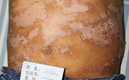 银屑病春季突然复发该怎么进行治疗