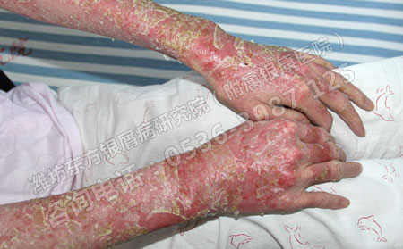 银屑病患者怎么调节心理呢