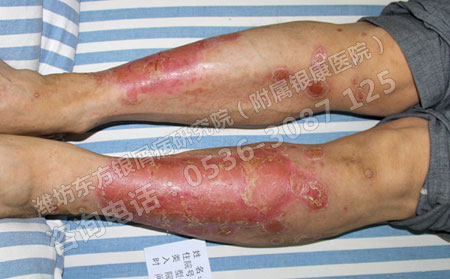 济南银屑病医院揭秘银屑病治不好的真正原因