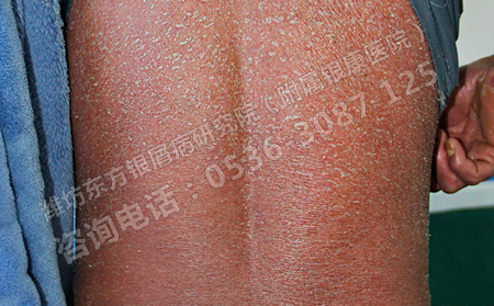 济南市能治疗重度银屑病的医院有哪些