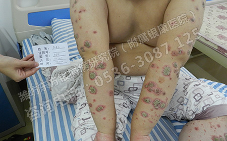 济南如何治疗银屑病效果好