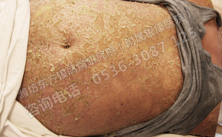 济南银屑病医院治疗银屑病的偏方