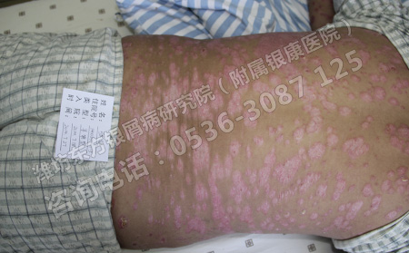 重度银屑病怎么治疗不复发