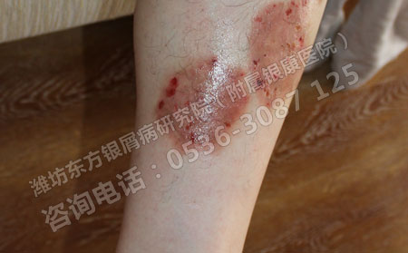 济南治疗早期银屑病需要注意什么问题
