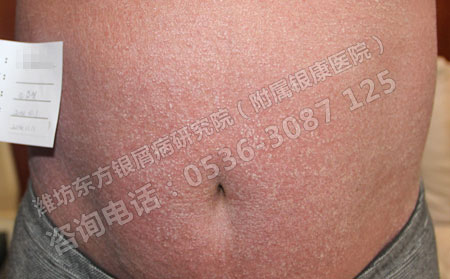 正规治疗银屑病要注意哪些细节