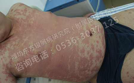 济南治疗银屑病的医院专业不专业