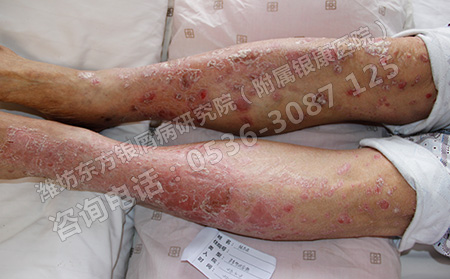 济南哪家医院治疗银屑病彻底
