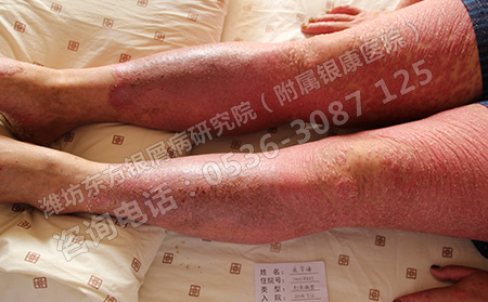 银屑病患者在日常的生活中要注意哪些问题