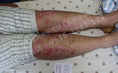 银屑病春季护理要做到哪些方面