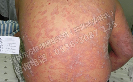中药疗法治疗银屑病的好处有哪些