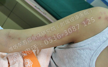 感冒引起的银屑病该怎么进行治疗