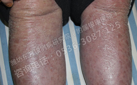 银翘病还有没有办法治好