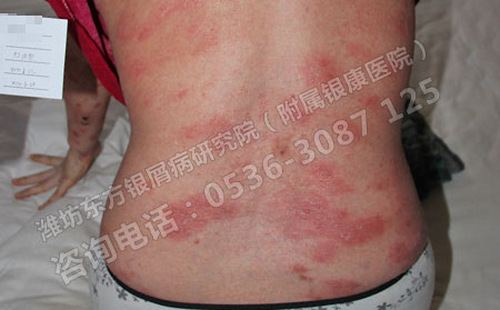 红皮型牛皮癣发病初期都有些什么症状