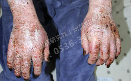 银屑病患者应该禁忌食用哪些食物?