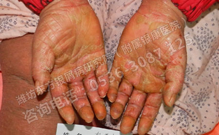 银屑病患者的治疗工作可以怎样注意使用偏方?