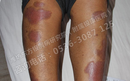 银屑病反复发作怎么才能护理好