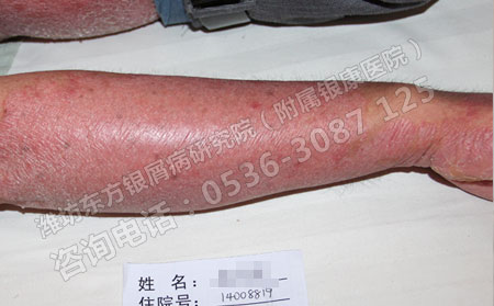 夏季银屑病预防方面需要注意哪些