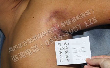 能够促进银屑病康复的具体护理做法是什么？