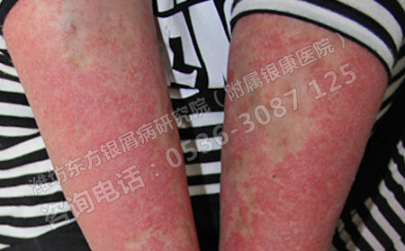 济南红皮型银屑病怎样治疗有效果？
