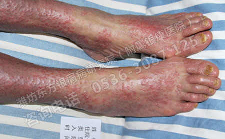济南儿童患有银屑病怎样治疗才有效果？