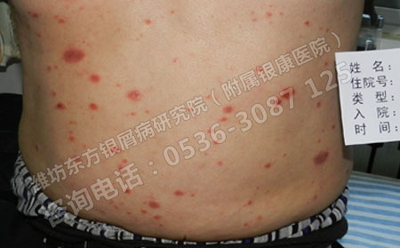老年银屑病患者在日常生活中应该注意的护理问题