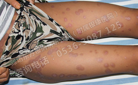 济南银屑病在日常生活中怎样护理才有效？