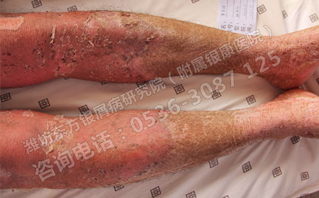银屑病患者在治疗期间需要重视哪些问题？