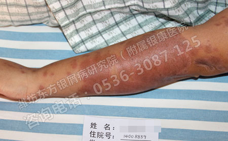 夏季银屑病患者在日常生活中该如何做好护理工作？