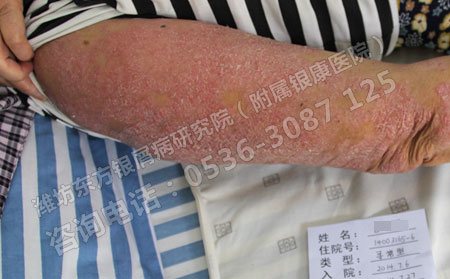 济南银屑病患者如何正确的治疗银屑病？