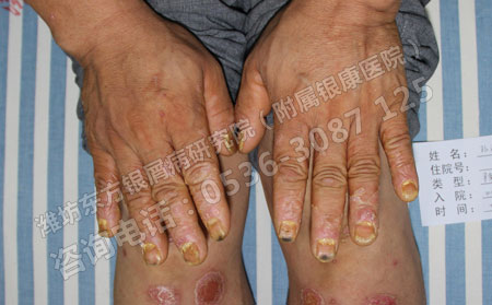 夏季银屑病患者出门应该注意哪些问题？