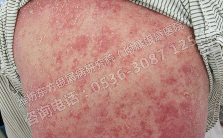 济南脓疱型银屑病怎样治疗才有效果？