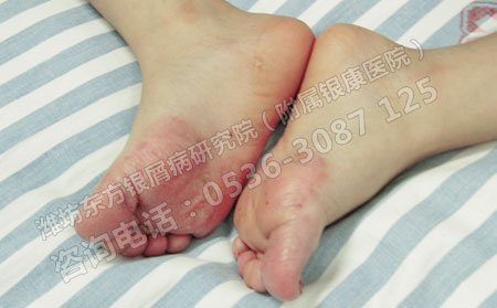 夏季银屑病患者应该怎样对抗银屑病？